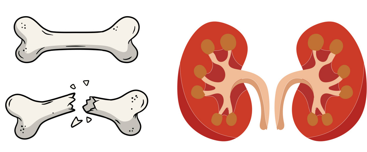 Renal bone disease and CKD - Chronic Kidney Disease Explained